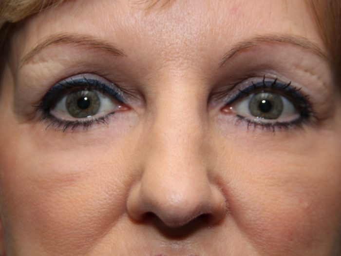 Laser resurfacing