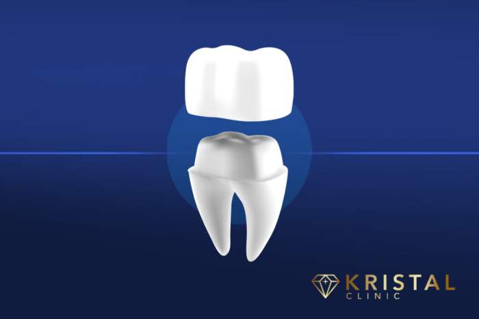 Dental crowns